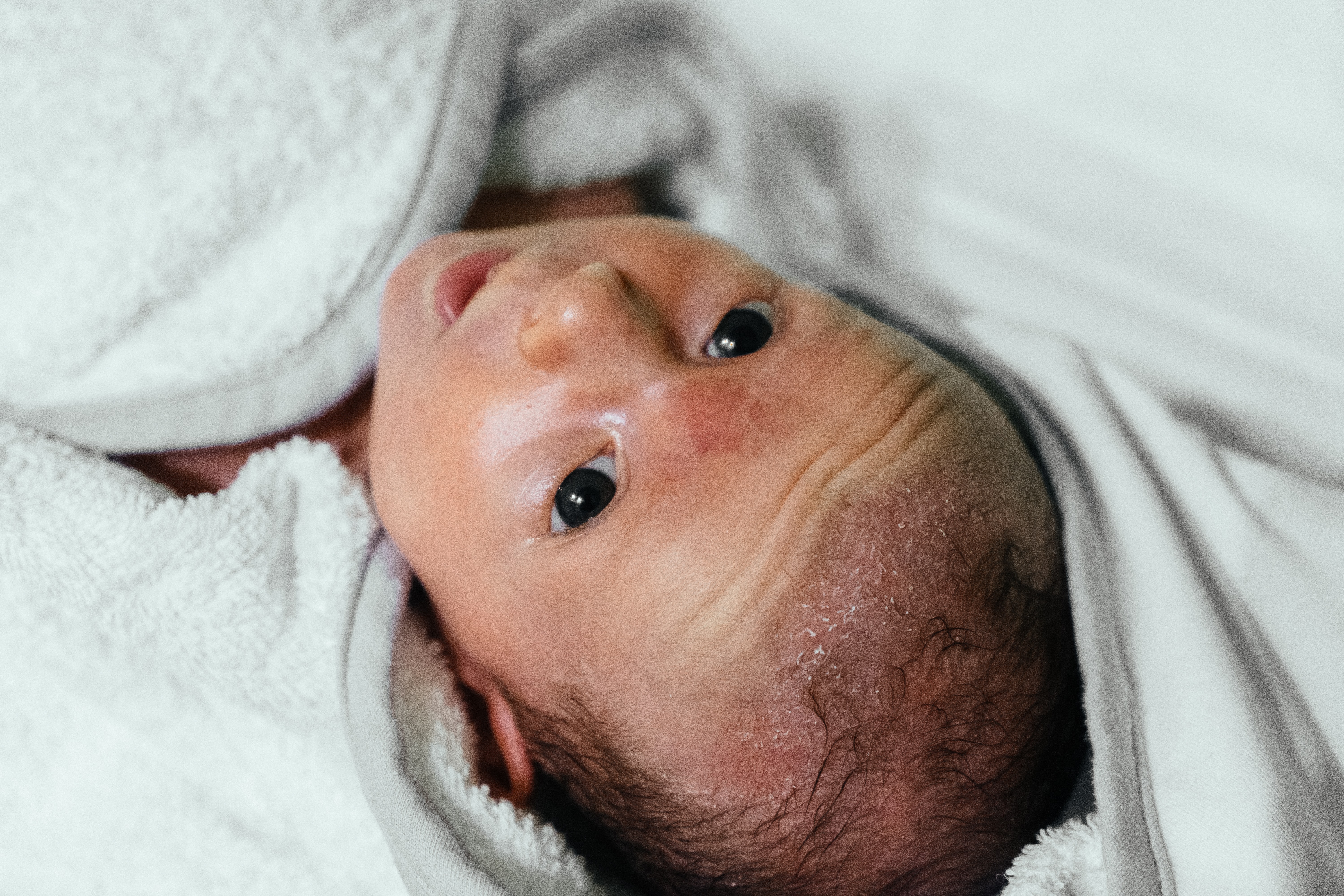 bijkeuken Bijdrage rechter Van acne tot eczeem: alles over huiduitslag bij baby's